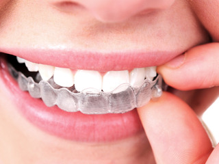 Nakładki Invisalign dla dzieci i dorosłych